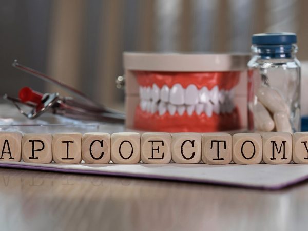 allaboutsmile-dental-Apicoectomy