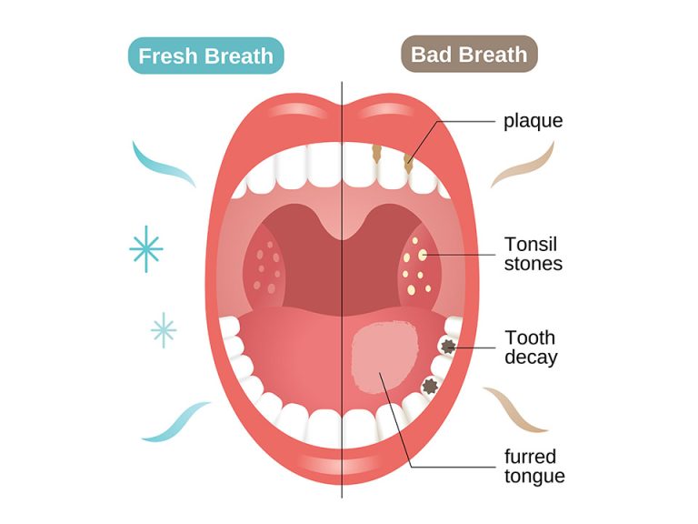 Tonsil Stones: Causes, Symptoms, and How To Remove Them - All About ...