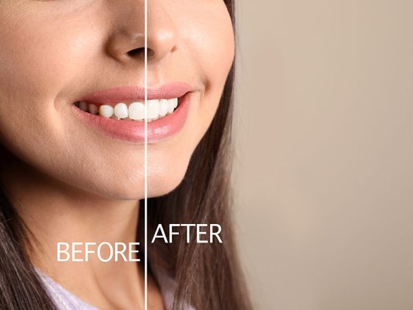 all-about-smile-dental-gingivoplasty gingivoplasty