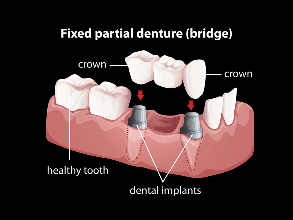 implants or dental bridges