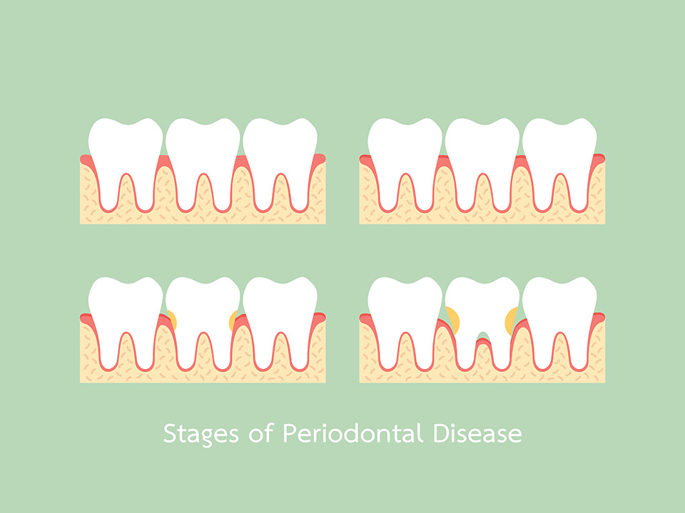 Gingivitis vs. Periodontitis: Key Differences & What to Do in Each Case