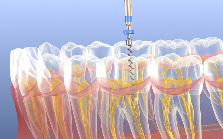 Endodontic root canal treatment process