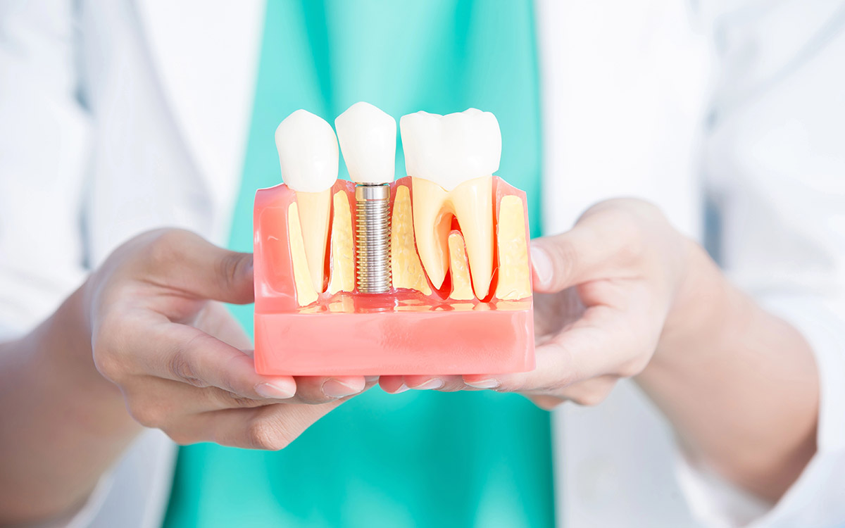 Encino dental impants