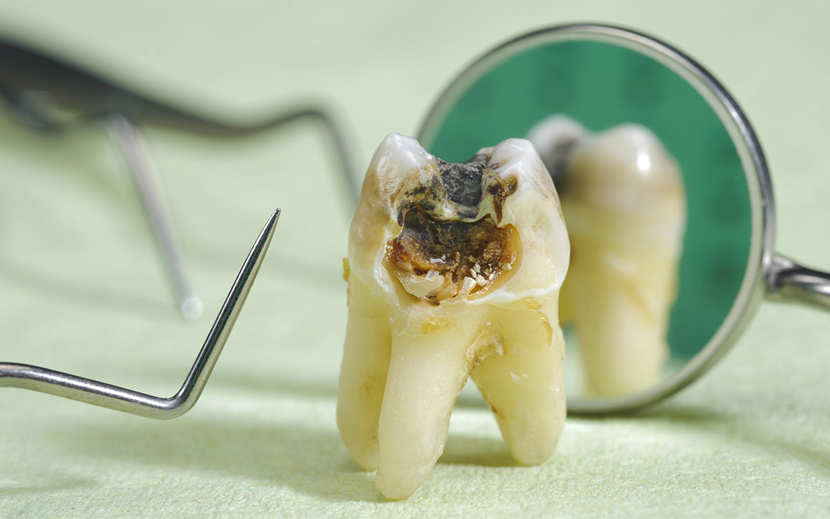 Tooth Decay